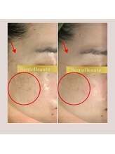 サンテボーテ(Sante Beaute)/【ヒト幹細胞フェイシャル4回】