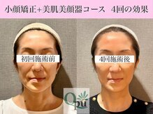 キュープ 福岡九大学研都市店(Qpu)/美顔器モニターコース４回の変化