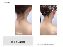 ユーセレクト ビューティー プラス(U-SELECT BEAUTY PLUS)/ブライダルに向けて磨きた方へ！
