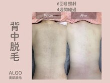 アルゴ 山口宇部店(ALGO)/脱毛初！全身脱毛6回目経過