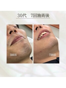 フォー(the 4)/before &nbsp;&nbsp;&nbsp;&nbsp;after