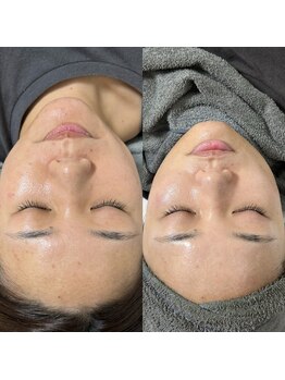 スムー 金沢小橋町店(Smoo)/ハーブピーリング