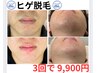 お得に始める◆ヒゲ脱毛(選べる3箇所)◆ 3回 9,900円