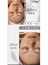 ビヨウイリョウテイケイ プリード(美容医療提携 PULIDO）)/ララピールbefore・after