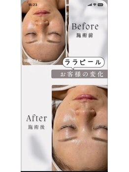 ビヨウイリョウテイケイ プリード(美容医療提携 PULIDO）)/ララピールbefore・after