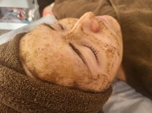 チル アウト(CHILL OUT)/大人気！ハーブピーリング