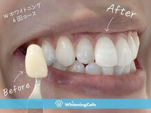 ホワイトニングカフェ 高松丸亀町グリーン店(WhiteningCafe)/◎歯のホワイトニング施術写真◎