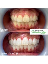 ホワイトニングサロン 名古屋駅店/【ホワイトニング施術例】
