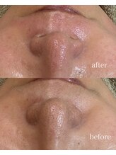 モンクラッシー(Mon classy)/毛穴、産毛、角質除去