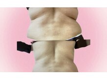 ヨサパーク ロワゾーブルー(YOSA PARK Loiseau blue)/背中のハミ肉がなくなった！