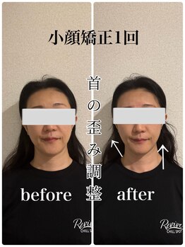 リバイブ 自由が丘店(REVIVE)/小顔矯正+ドライヘッドスパ1回