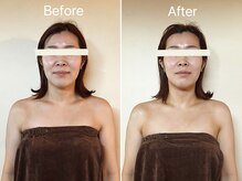 アリス(Alice)/フェイシャル小顔矯正