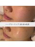 【毛穴、顔の赤み、肌荒れにお悩みの方】平日限定！ハーブピーリング