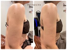 パルティール(PARTIR)/二の腕やせ　マイクロリフト