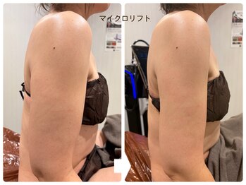 パルティール(PARTIR)/二の腕やせ　マイクロリフト