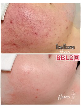 ハノン(Hanon)/BBL光フェイシャル経過写真