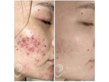 リファッション 新宿店(Refashion)/効果絶大!!ハーブピーリング