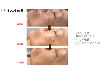 キラベル 平塚店(KiraBelle)/光フェイシャル