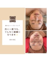 イルソーレ(IL Sole)/定期的ケア/ハーブピーリング
