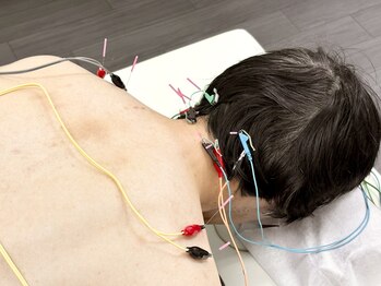 とだ鍼灸院/《鍼灸施術》首肩レスキュー鍼灸