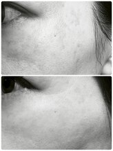 オリエンス(oriens)/ハーブピーリング