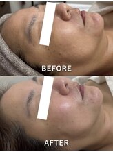 ブランシュムーニー(BRANCHE MOONY)/サーマトリックス＆ララピール