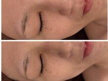 イディアル(IDE'AL)/陶肌トリートメント