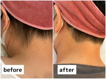 プレヴェール 神戸三宮/うなじ脱毛 めちゃスッキリ