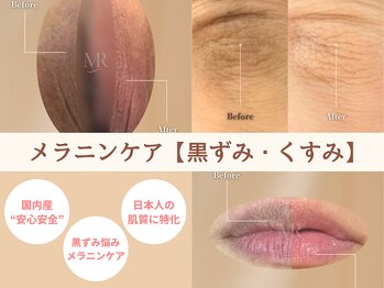 フェミニン(Feminine)の写真/フェムケアサロンで安心の短期集中ケア！メラニンケアで黒ずみケアを目指す★