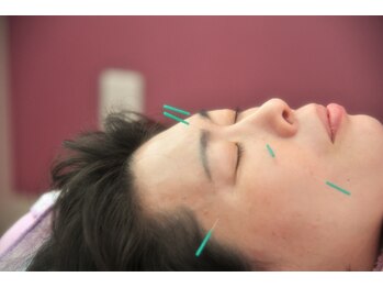 クローブ鍼灸院(CLOVE鍼灸院)/美容鍼で小顔に♪頭痛も解消！