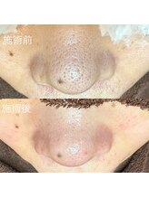 エクラ バイ シャンリィ(eclat by shanLy)/黒ずみ解消