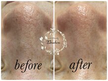 ニコサロン(25salon)/ハイドラフェイシャル