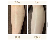 モアトゥインクル 山口店(MORE twinkle)/★症例写真★