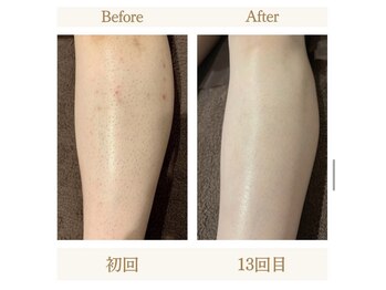 モアトゥインクル 山口店(MORE twinkle)/★症例写真★