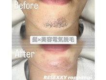リゼクシー INTERNATIONAL麻布十番 六本木(RESEXXY)の雰囲気（気になる髭も美容電気脱毛でスッキリ！デザイ髭・白髪髭も可能！）
