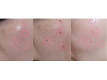 ルナソル 昭島店(LUNASOL)の雰囲気（痛みの苦手な方も◎低周波シミケア）