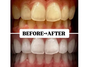 ホワイトニングサロン 豊中/Before&After美白ホワイトニング