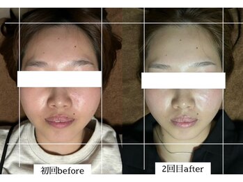 ダイアリー(DIARY)/小顔矯正