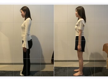 小顔矯正整体サロン イクサス(IxAS)/約3ヶ月/計6回の<before&after>