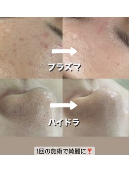 アールエム ボーテ(RM beaute')/プラズマ　ハイドラ（毛穴洗浄）