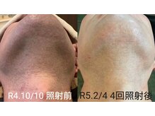 ロリコクア(loli kokua)/ヒゲ脱毛