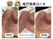 ディレイア ザ コスメ 有楽町マルイ店(direia the cosme)/メンズ/皮脂/角栓［有楽町］