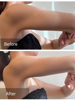 エヌア(nA)の写真/気になる二の腕や脇まわりの“はみ肉”へ徹底アプローチ★短期間で印象が変わる、結果重視のボディケア♪