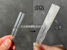 ニコ(nico)/毛穴ごっそり！毛穴吸引