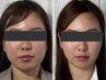 【リバウンドしない・針を使わない脂肪分解】脂肪分解5ml導入　120分