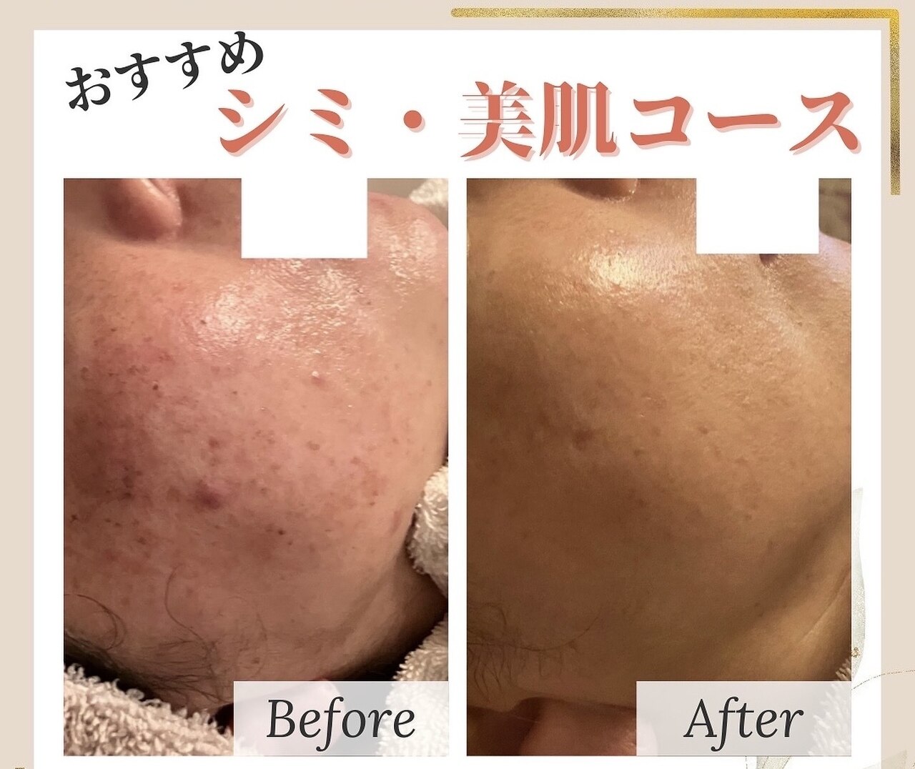今福鶴見駅で毛穴黒ずみが人気のエステサロン｜ホットペッパービューティー