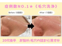 ウル 下北沢(Ulu)/韓国式３D毛穴洗浄