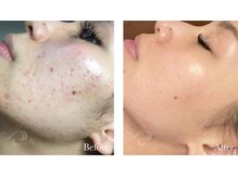 カノン(Kanon.)/リベルハーブピーリング