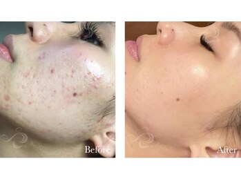 カノン(Kanon.)/リベルハーブピーリング