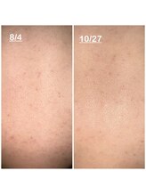 ミニョン(mignon)/モニター結果